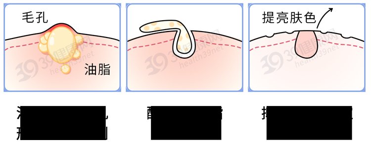 抗衰老|祛痘控油抗衰老？「刷酸」真的那么神奇吗？其实只有这4类人适合