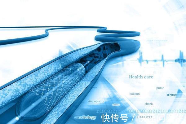 治療|得了冠心病就必須要安裝支架？只有這幾類，才真正需要做手術