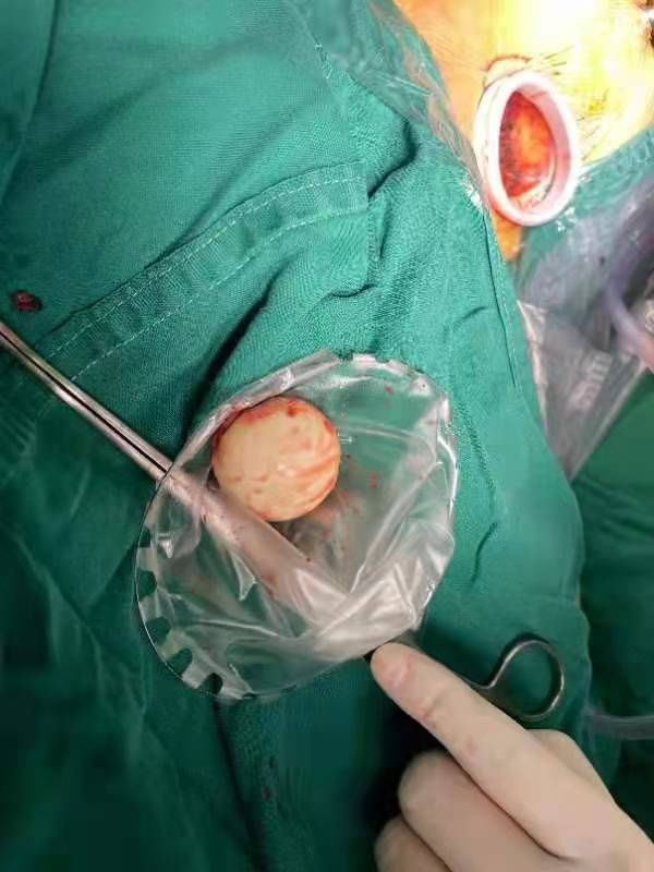 王海涛|去哪儿？中年女子肩部突然少了块骨头，原来“穿越”到这里