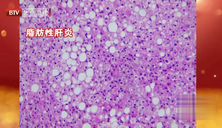 茶多酚|得了脂肪肝,全身都受累,4大癌症风险骤增,还伤血管!这份“逆转方法”请收好~