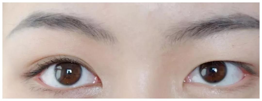 内双与单眼皮割双眼皮有何不同？