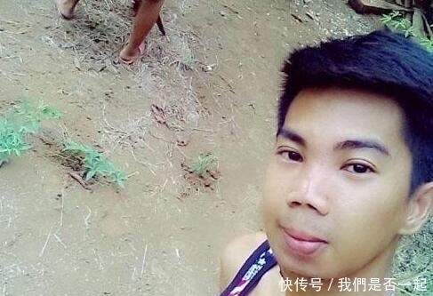 小伙花费70元整容,结果整容失败致脸部溃烂,帅小伙变成“丑男”