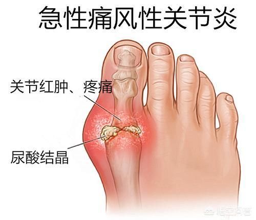  痛风发作|痛风的“元凶”是什么？