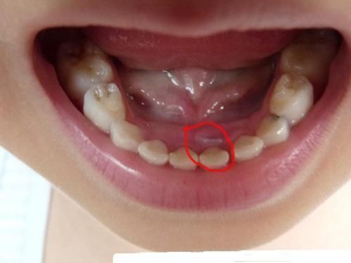 男孩|4岁男孩长出双排牙,只因父母太过“细养”孩子,医生太无知