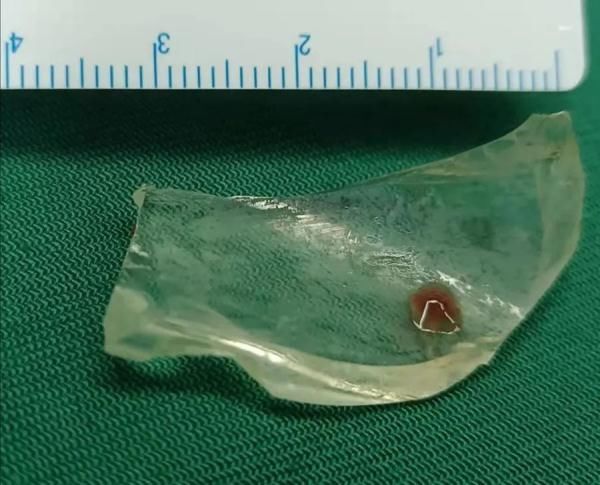 胸腔|惊!男子胸腔藏了块玻璃,11年不自知……