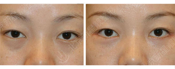 有什么原因导致外切去眼袋的失败 快资讯