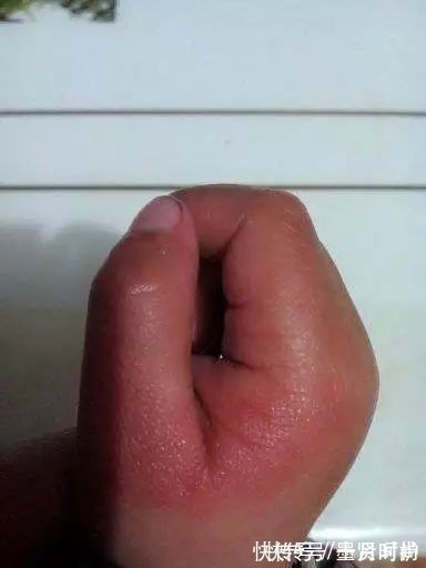 手指|三岁女童被活活截断手指,终生残疾!只因用错创可贴,快自查