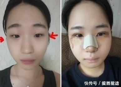 小脸|小脸确实更可爱,看完整容过程,只觉得满屏的疼痛