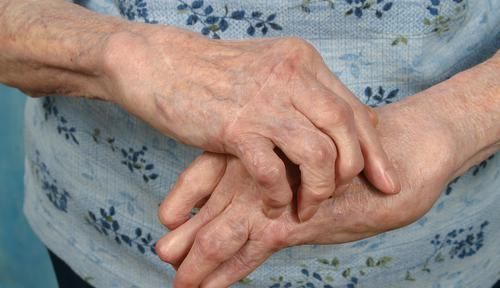  湿热|流传千古痛风名方，彻底驱除风寒湿，把痛风、风湿、类风湿都搞定