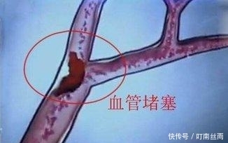 脑血管病|体内有没有血栓,看这里就知道,6个症状别忽视,为家里老人看看