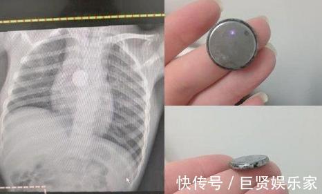 项链|5岁女儿暴瘦,医生检查后让娃“摘下项链”,妈妈懵了她没戴啊