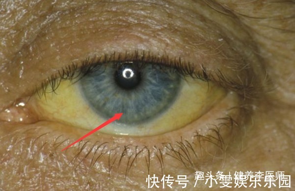 肝功能受损|“肝不干净”,眼睛会“说话”,若有3种“迹象”,肝炎或已来袭