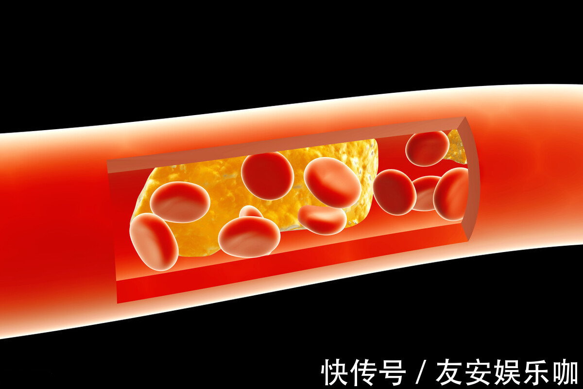 心脑血管疾病|最新研究：控制饮食，来降低“坏血脂”，能大大节约医疗费用！