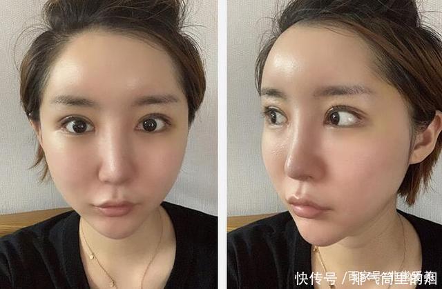 韩国妹子做眼鼻和脂肪填充，网友看到恢复照说侧颜秒杀金泰熙！