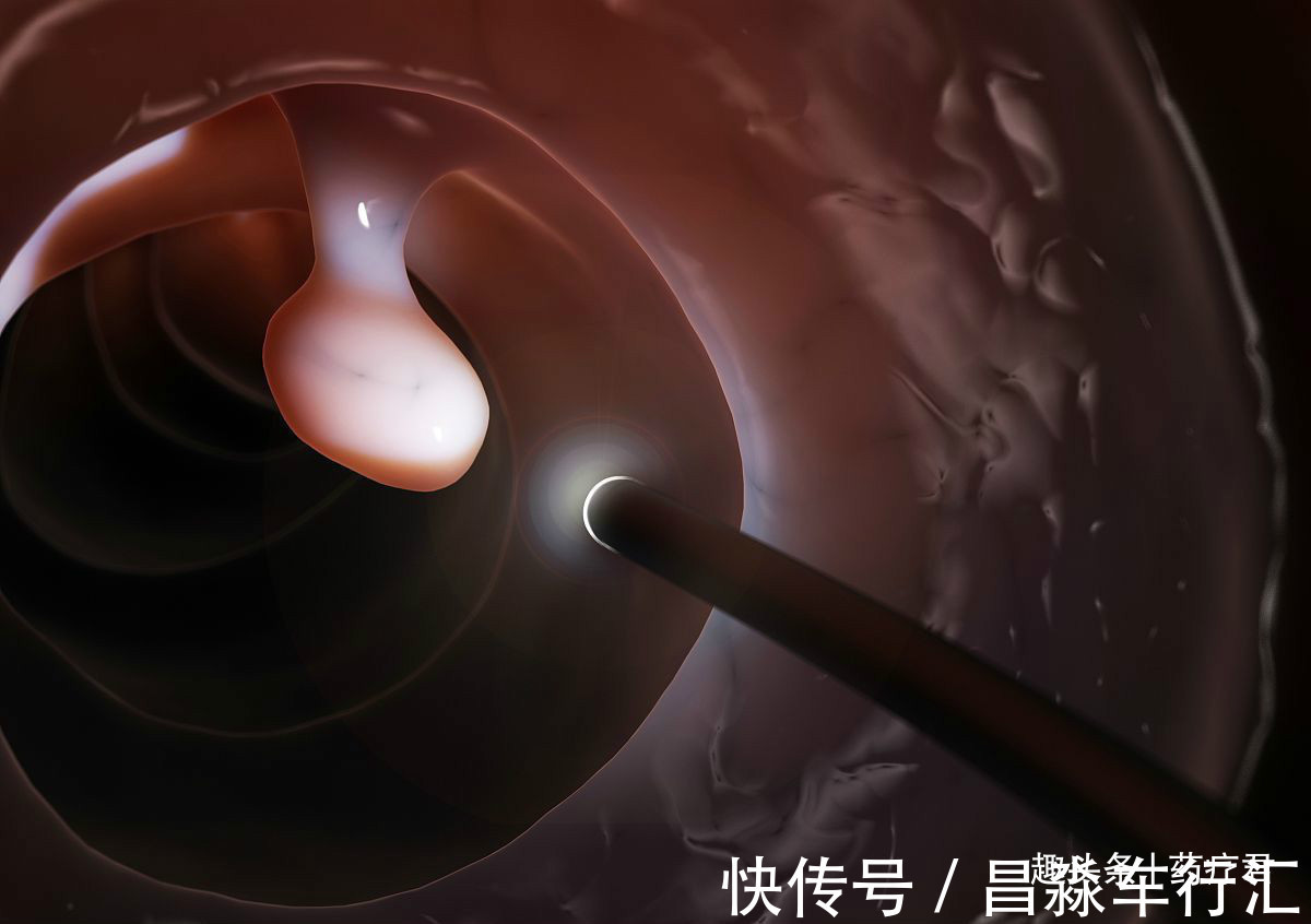 绒毛状腺瘤|肠子里长息肉后,身体会有什么感觉?为什么切了息肉还会得肠癌?
