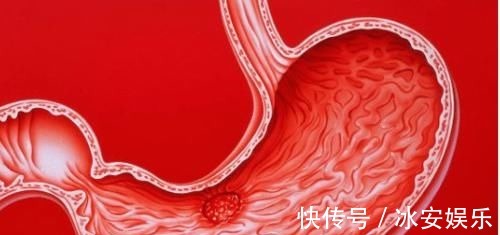 胃黏膜|消化科主任建议:胃不好的人,尽量少吃这3类食物