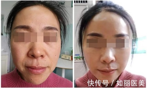 双保险 拉皮手术为什么要植入线或者提拉带？和线雕有什么区别？