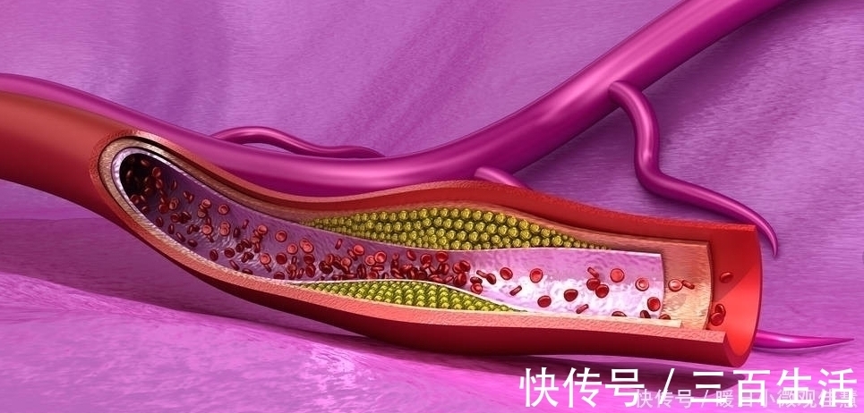 院士|院士总结高血压的根源不止是盐,远离这4种食物,血压才能稳定