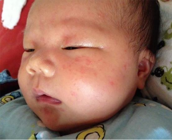 行为|儿科医生奉劝不想宝宝总被湿疹折腾,妈妈5个行为少对宝宝做