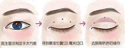 重睑术是什么?俗称割双眼皮,双眼皮手术