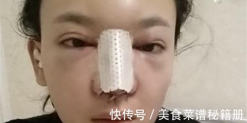自然风格 隆鼻术后假体穿透鼻尖,这也太吓人了!