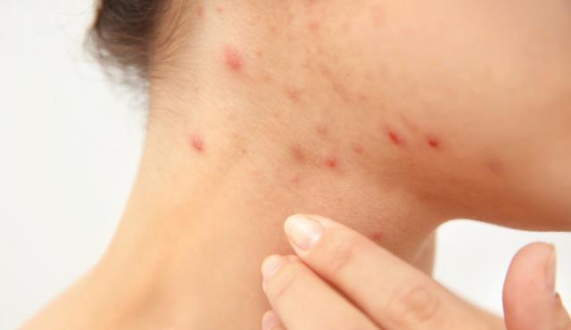 脸上出现3种症状?可能是脾虚!用天价护肤品都不如养养脾