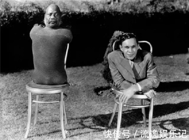 畸形#可恨又可悲的“龙虾手男孩”:畸形跟了他一生,最后死在妻子手里