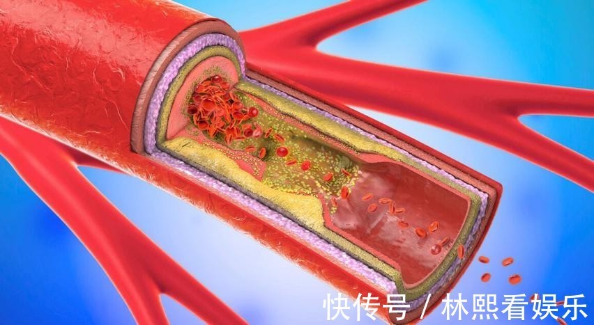 血管|血液“稀释剂”已公布，洋葱靠边站，每天补充一点，脑梗不接近