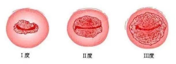 妇科|5分钟教你看懂妇科体检报告单!有些病可能是唬人的“纸老虎”!