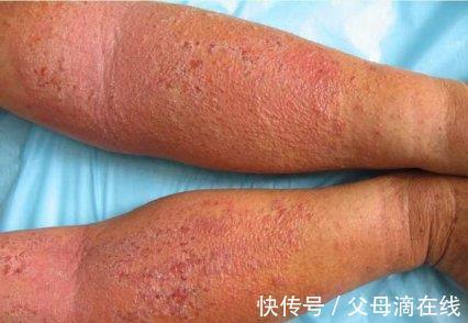 合理用药|湿疹缠身怎么办？这3个小诀窍，让你跟湿疹说拜拜