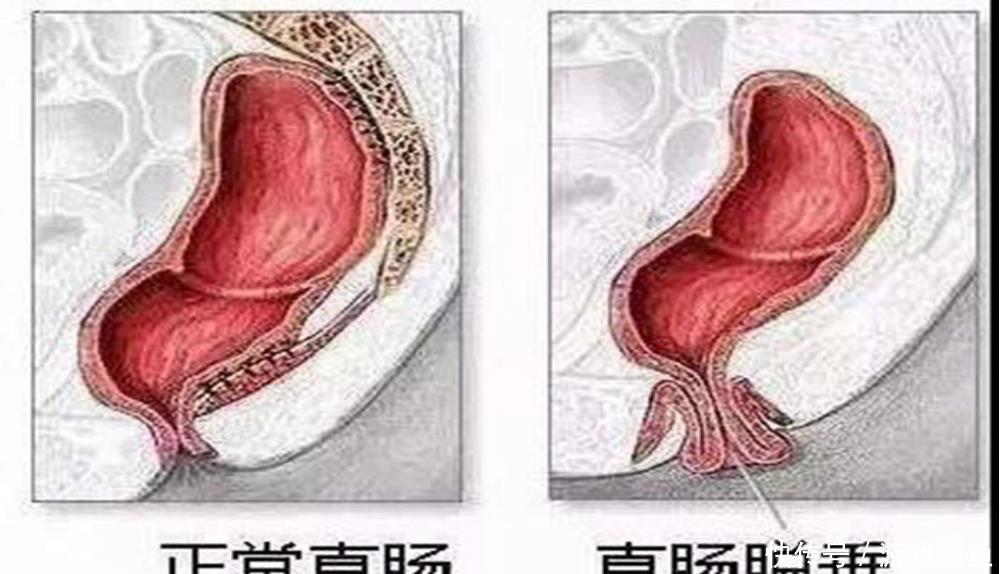 肛门|便后有肿物脱出，就是痔疮犯了？教您正确认识“直肠粘膜脱垂”