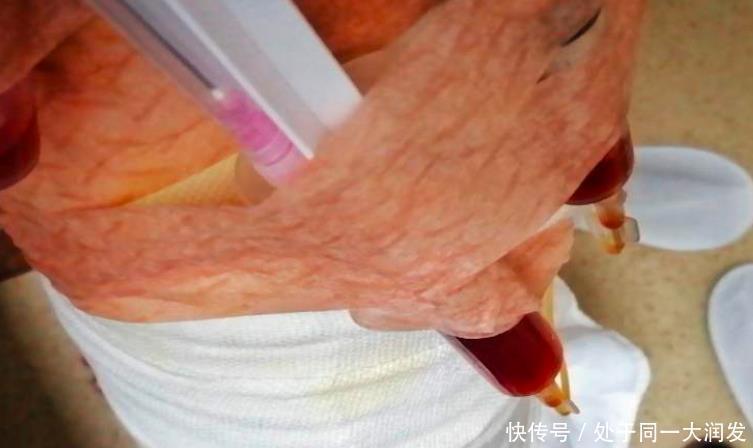 创口|女子去医美抽脂,背部创口溃烂缝不了针,竟仍选择做双腿吸脂手术