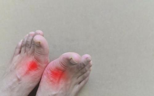 副作用|尿酸升高、痛风发作，哪种降酸药见效快、副作用小？医生回答了