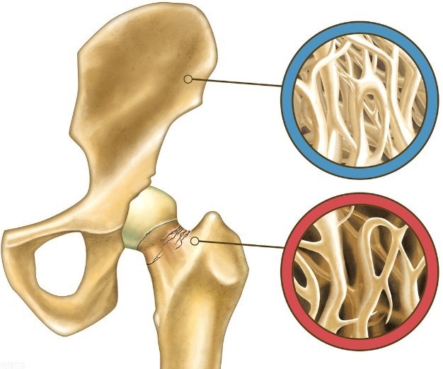 骨骼|43岁女子,每天喝牛奶治疗骨质疏松症,结果如何值得借鉴吗