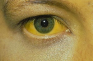 加速器|肝硬化''加速器''不止是酒,提醒这2件事再做,伤肝更要命