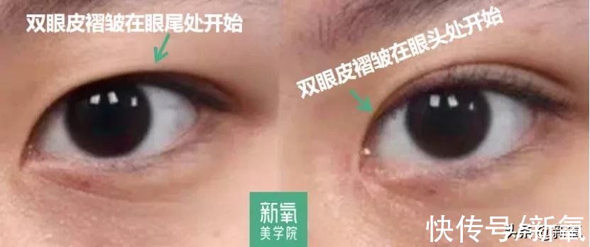 眼距&很多人都混淆了眯眯眼和小眼睛的区别