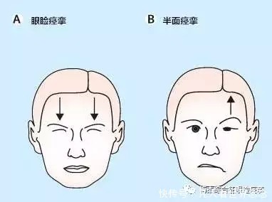 眼睑痉挛治疗方向你走对了吗?