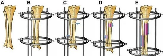 武大郎|为实现长高梦想,花16万断骨增高的李亚诺,如今过得快乐吗