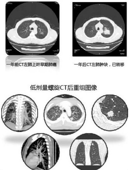 显微镜|吸烟与肺癌有必然联系吗？医生这样说