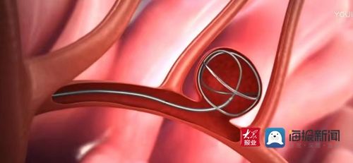 血管健康|中医来了·关爱健康从“头”开始④：关注脑血管健康状态 解绑颅内“定时炸弹”