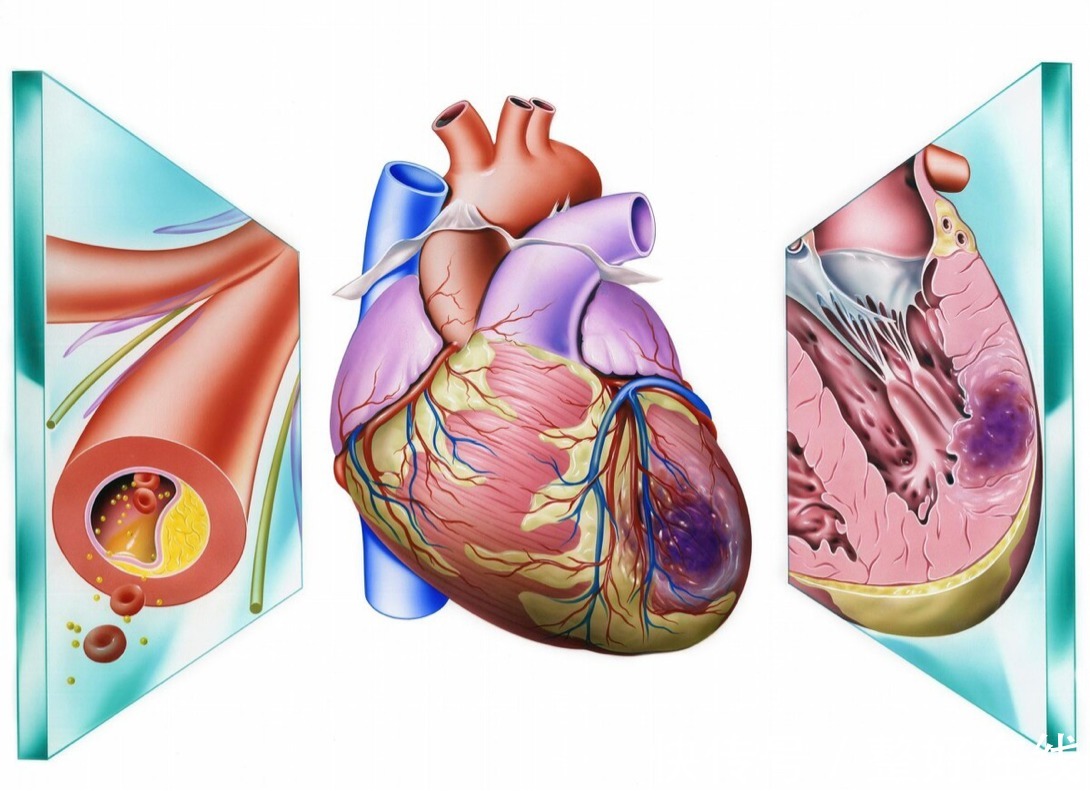 猝死|冠心病严重会猝死十分危险?以下几个方法帮助调养身体,远离冠心病