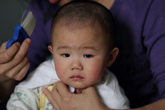 家长|孩子被烫伤后,是先脱衣服还是先冲冷水家长一定要提前知道