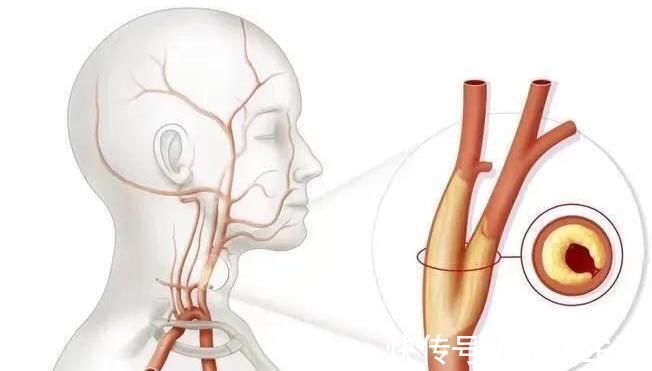 血栓|这4种食物比肥肉还升血脂,尽量少吃点,有助于保护血管!