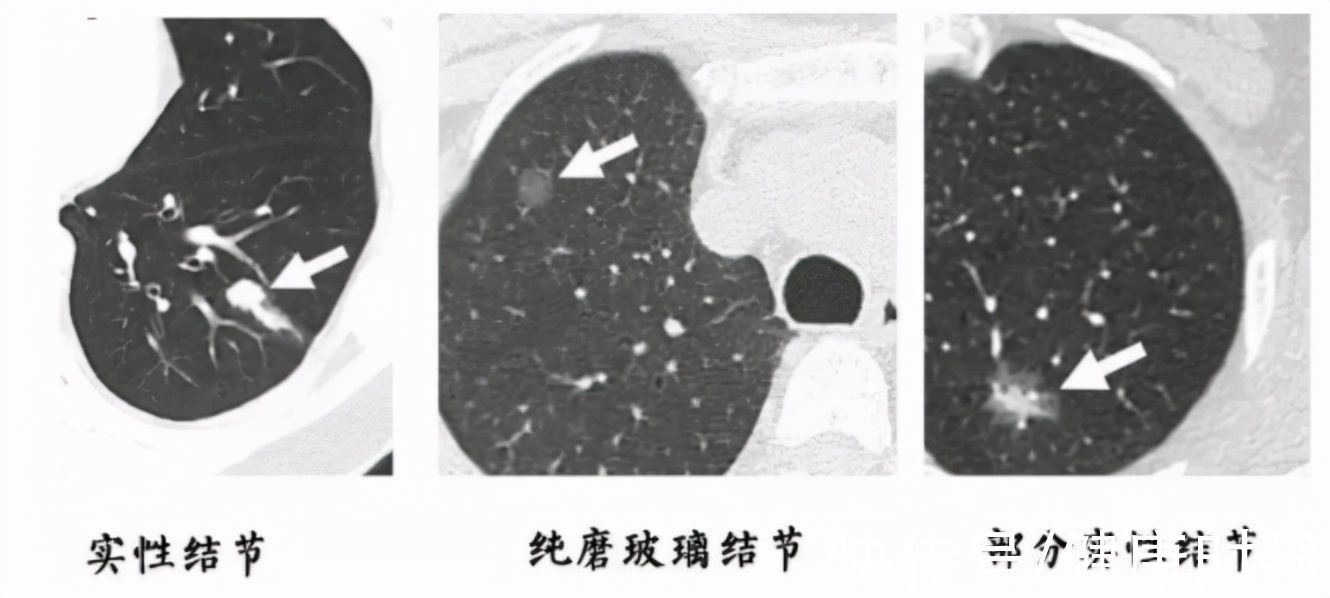 结节|结节、息肉、囊肿、增生、肿瘤标志物，到底哪个离癌症更近？