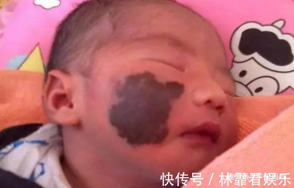 化学物质|越来越多胎儿被“胎记”缠身,若不想孩子自卑,孕妈要管住自己