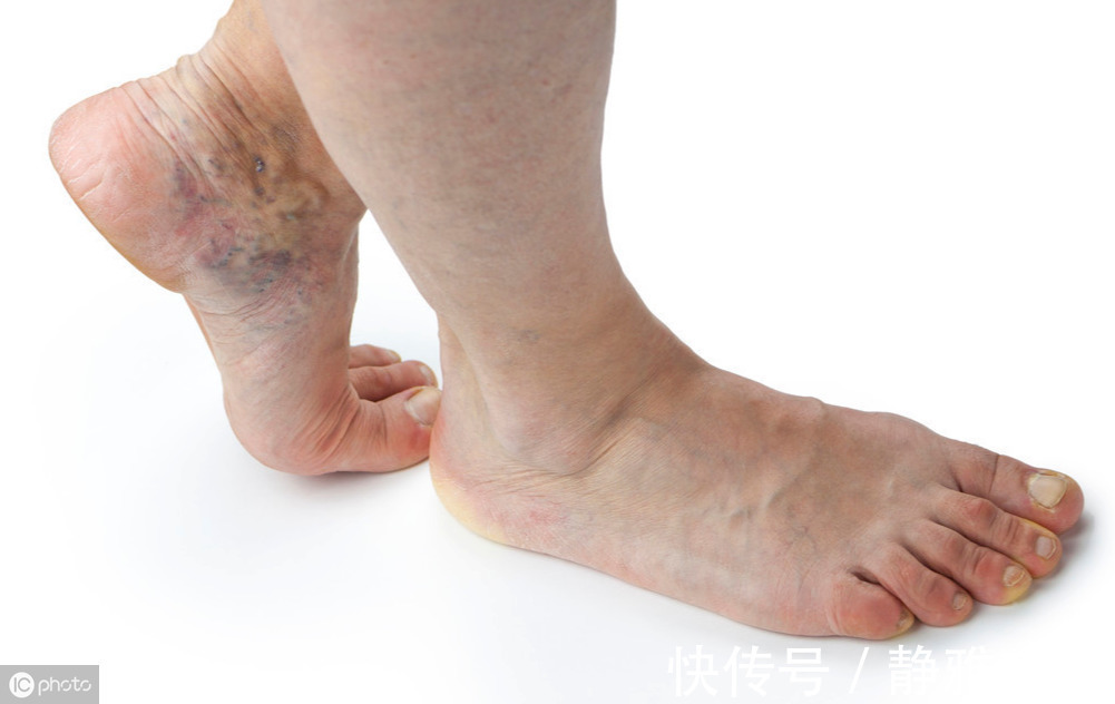 当心|腿部出现4个信号,当心是癌细胞扩散,记得去医院检查一下