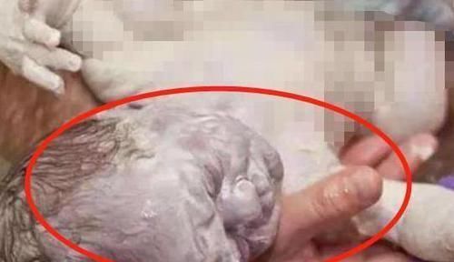 小李|十月怀胎,孕妇产下“雪人”宝宝,宝爸都被宝宝外貌吓到了