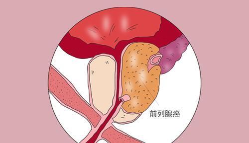  代表|患上癌症就代表“死路一条”？医生坦言：有3种癌治愈率比较高