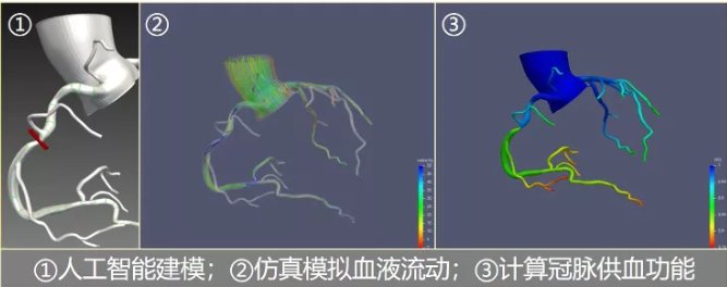 ct|【健哥说心脏】新出的CT-FFR技术，有用吗？