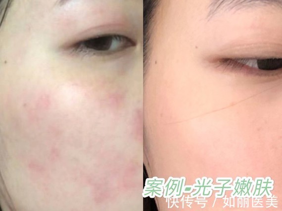 医美 你是敏感肌吗？敏感肌适合做什么医美项目？ 如何做好日常护理？